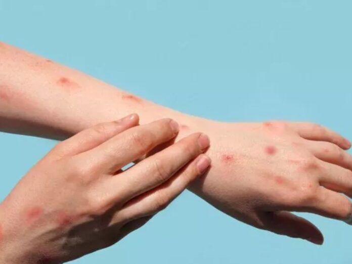 monkeypox