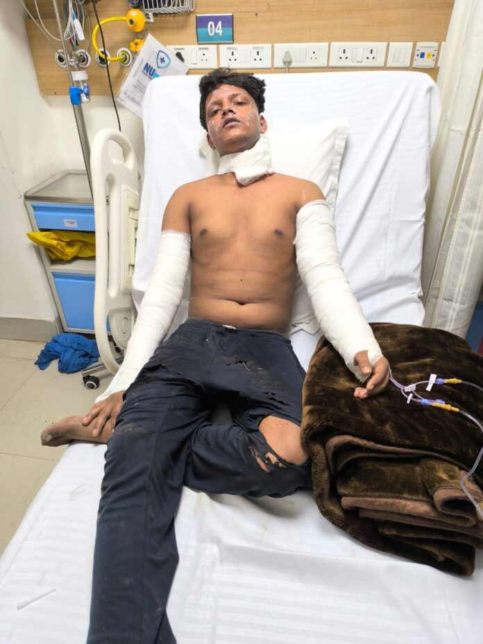 Boy suffers severe burns in the fire from illegal vendor's has leak,, saved by a resident Satya Prakash