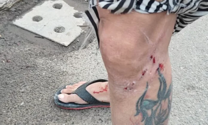 IT engineer injured after German Shepherd attack, residents question pet safety norms