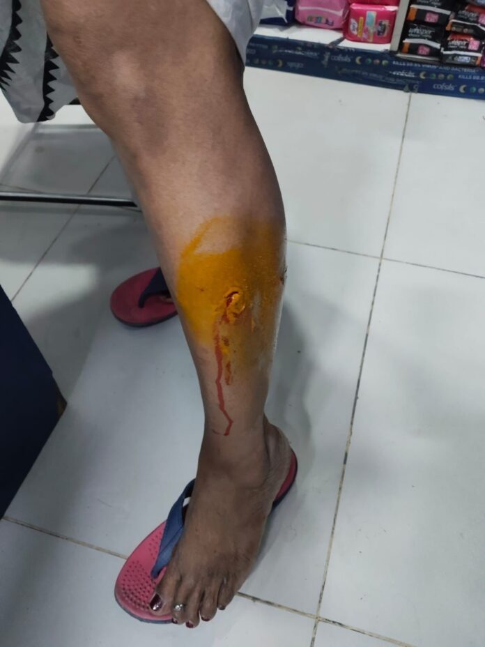 Stray dog menace escalates in Greater Noida’s Sector Beta-1 as repeated attacks on residents raise serious safety concerns.